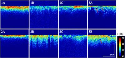 The neurosurgical benefit of contactless in vivo optical coherence tomography regarding residual tumor detection: A clinical study